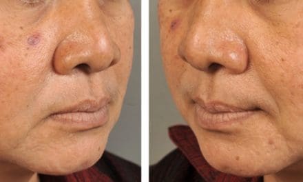 สารพันปัญหาเรื่องของฝ้าสำหรับผู้หญิง